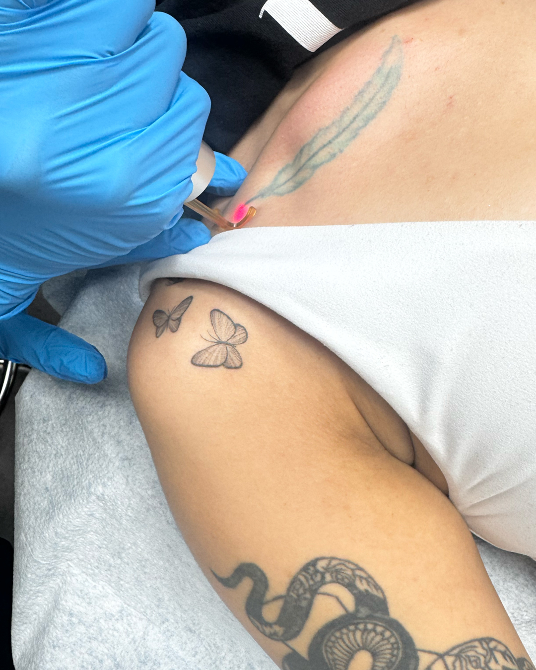 First session of laser tattoo removal on a complete removal package