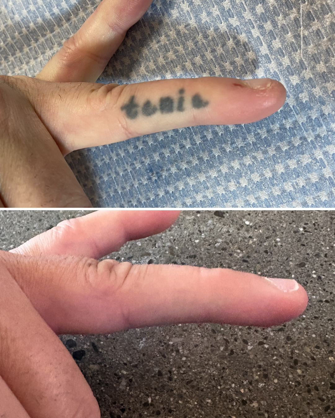 Name tattoo on the side of the finger, cleared in six sessions.