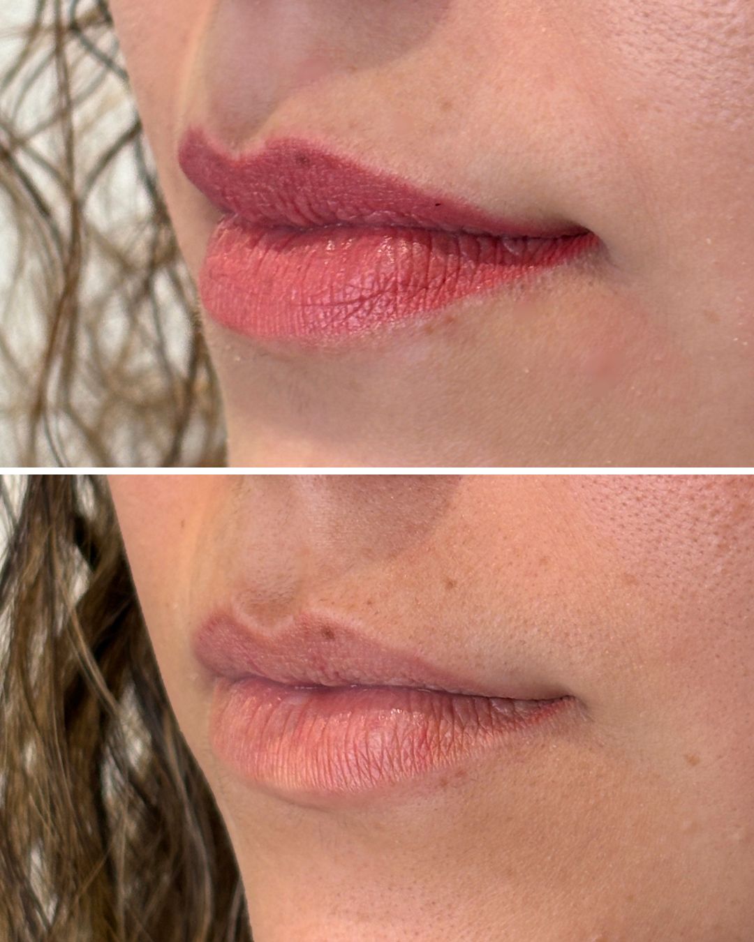 Lip blush removal after one session, from the side.
