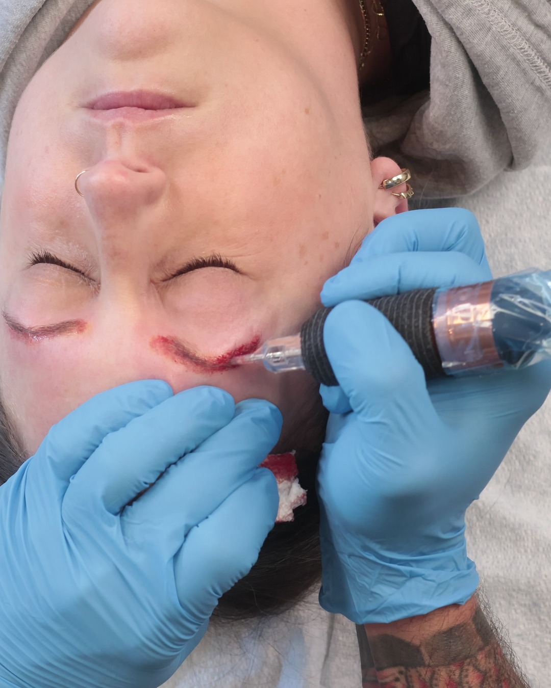 Saline removal on brow pigment, seen from above