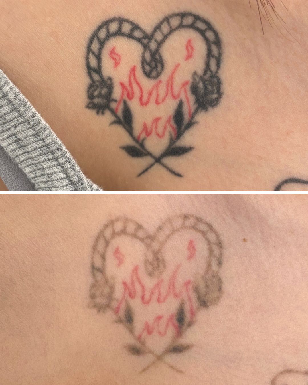 Colour heart on the chest faded over six sessions.