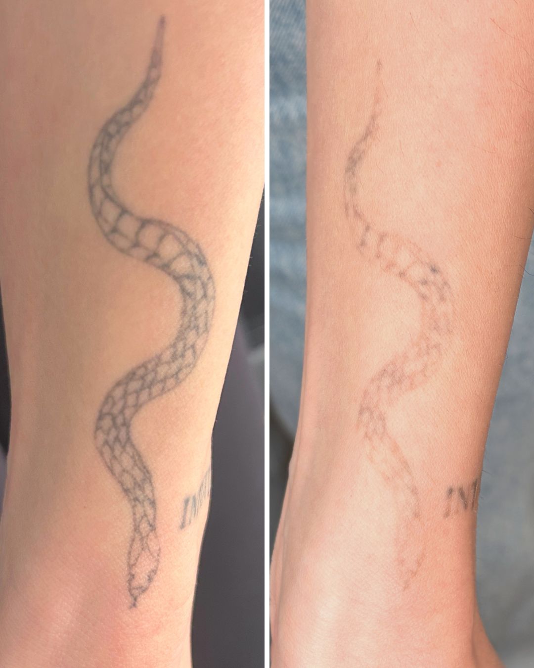 Snake forearm tattoo faded in two sessions.