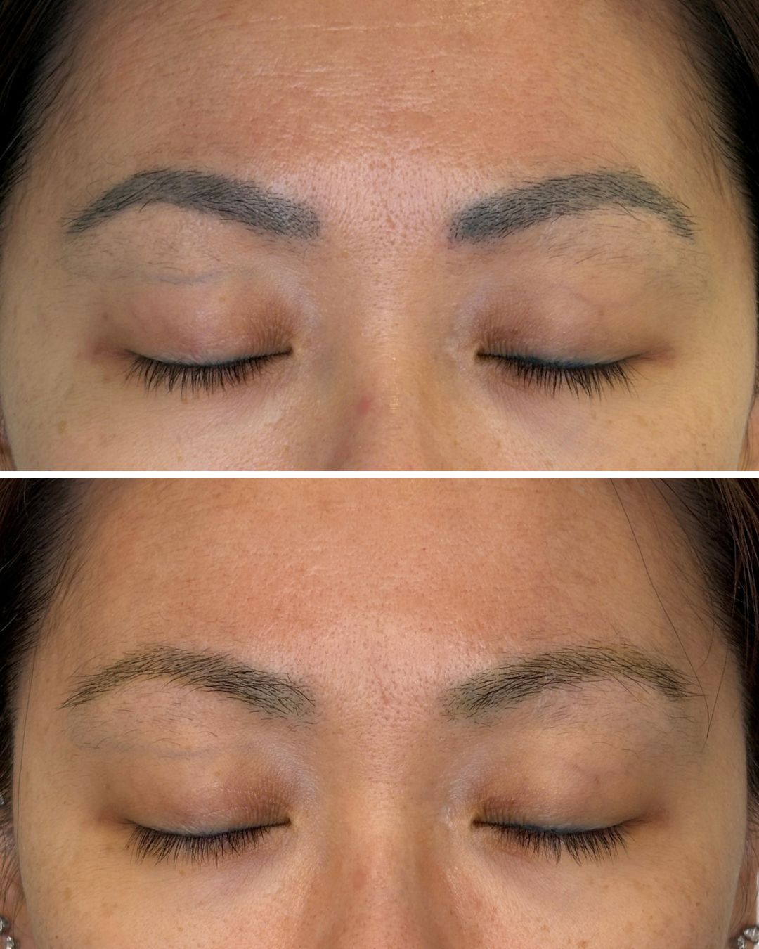 PMU brow removal after a single session.
