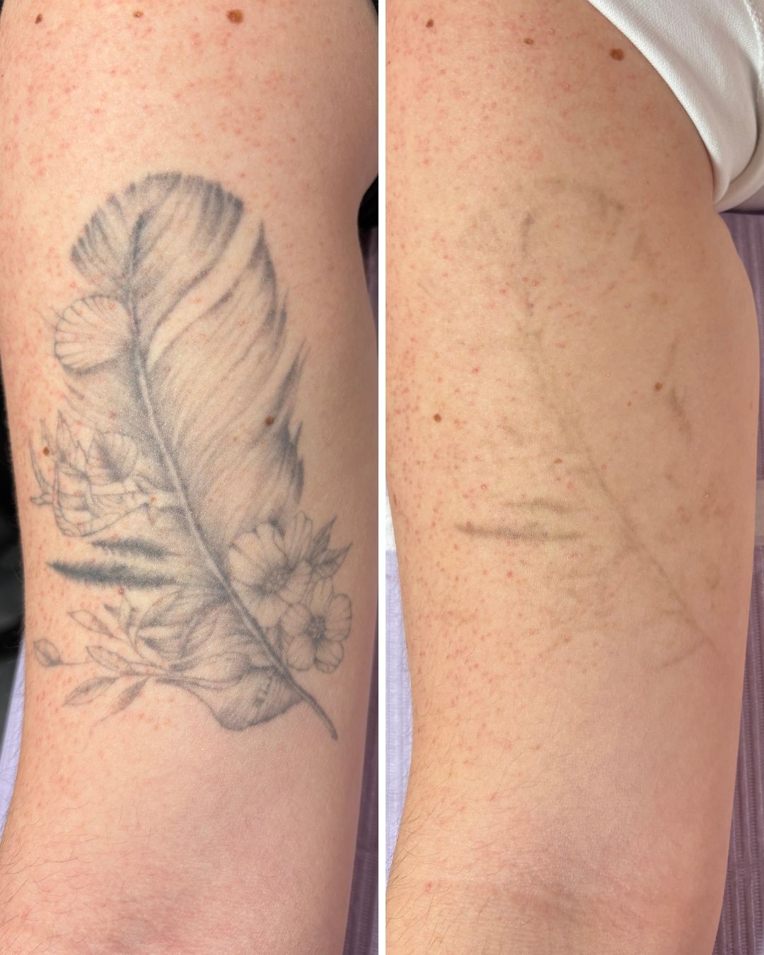 Feather on the forearm faded in three sessions.