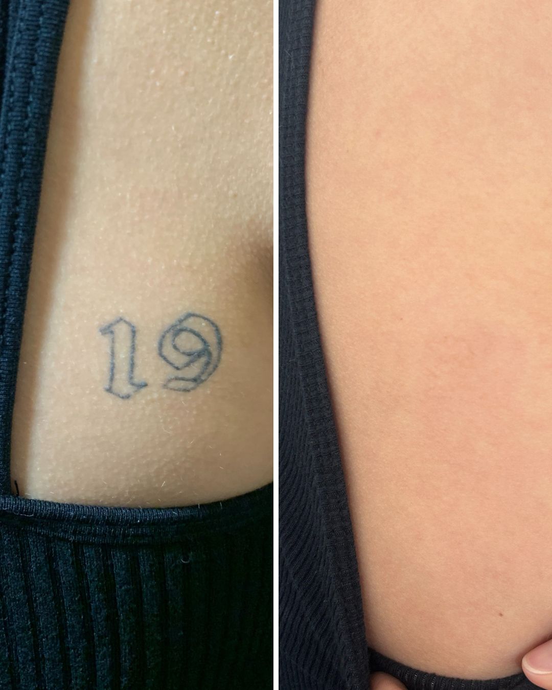 Small rib tattoo cleared completely.